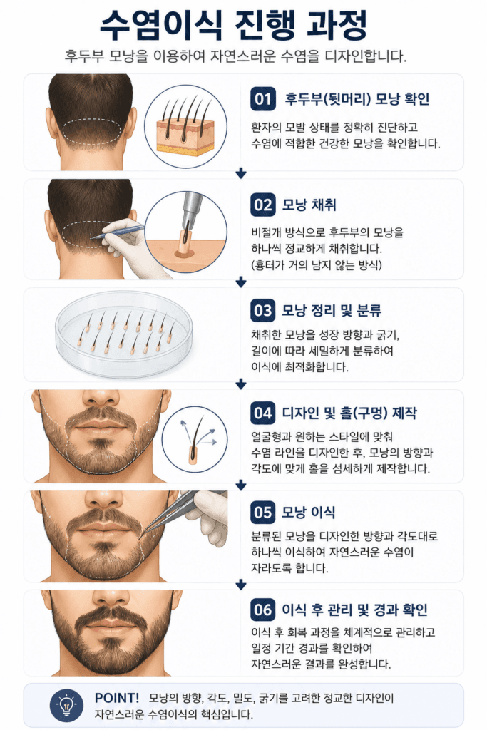 후두부 모낭을 채취하여 수염 부위에 이식하는 수염이식 과정
