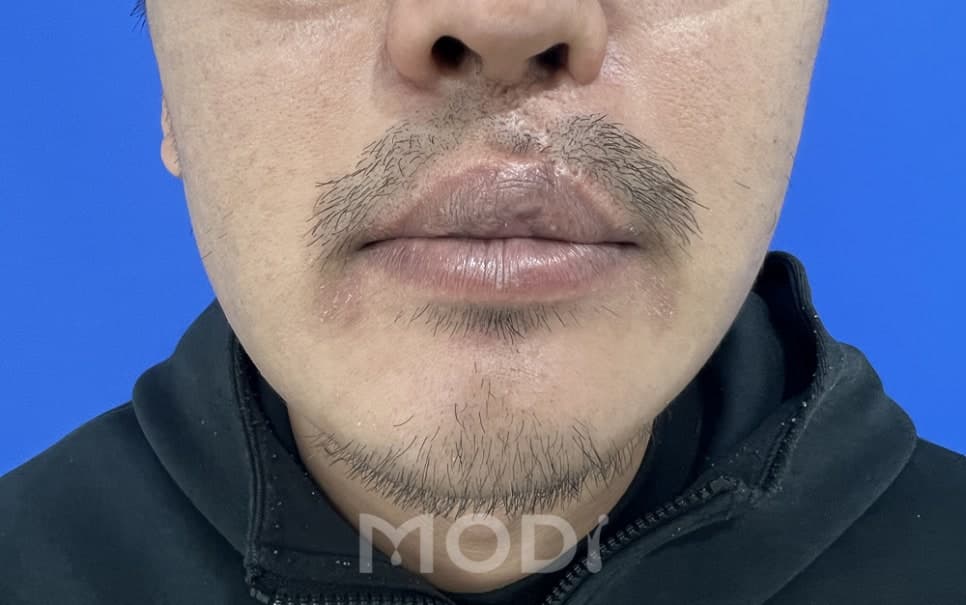 콧수염과 턱수염 수염이식 전 사진