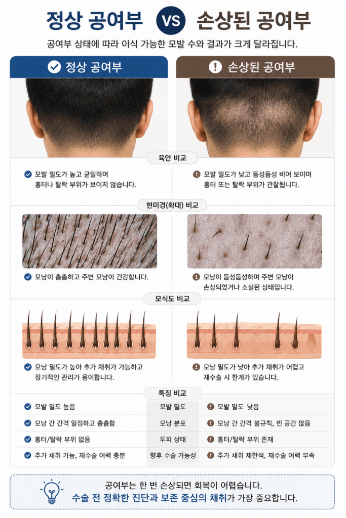 정상 공여부와 손상된 공여부 비교 이미지