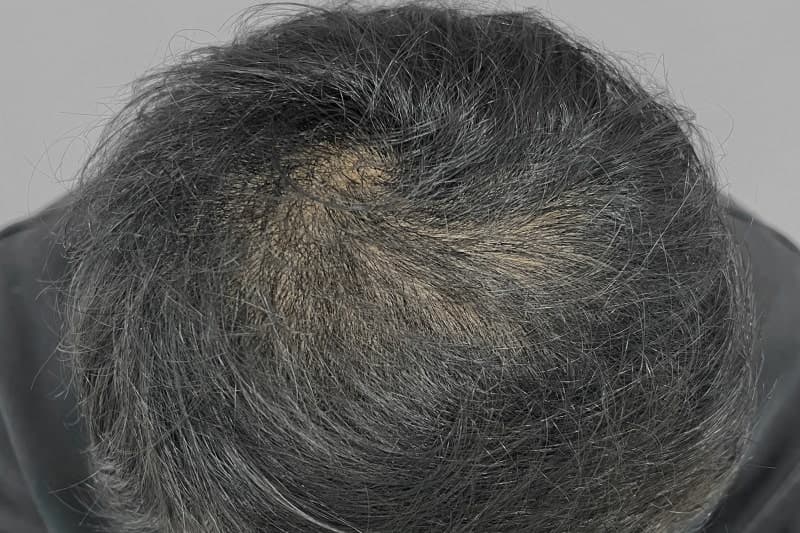 모낭줄기세포 치료 정수리 탈모 개선 사례의 치료 3개월 후 사진