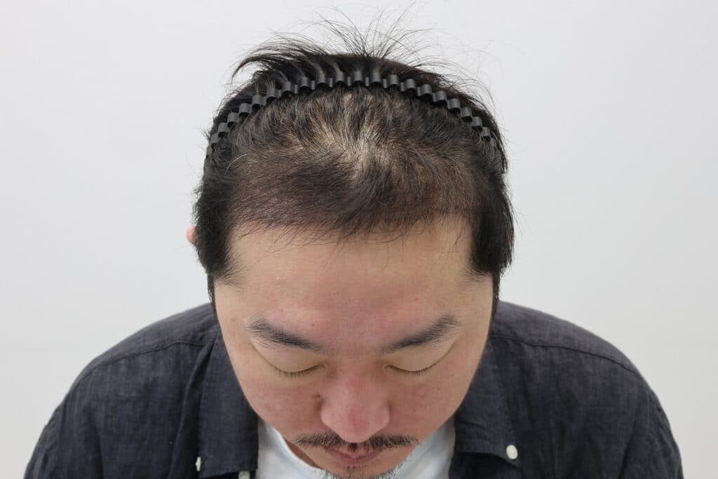 모발이식 수술 4개월 후 환자 사진