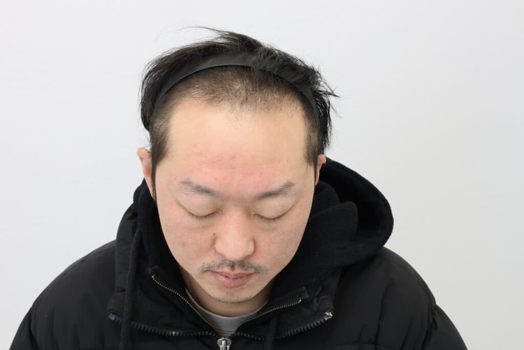 모발이식 수술 전 환자 사진