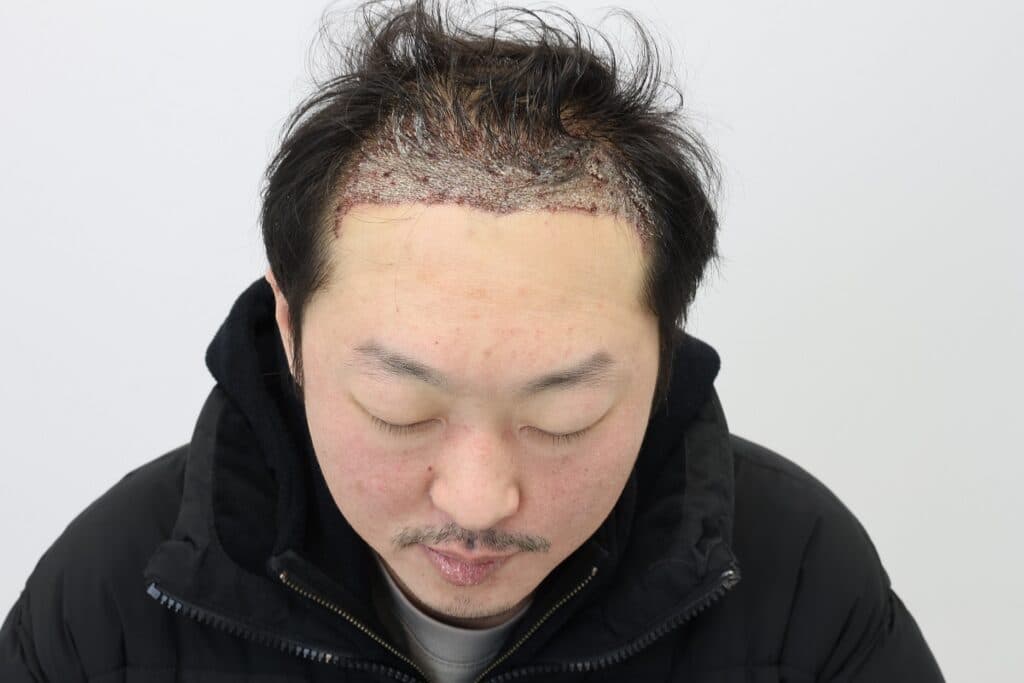 모발이식 수술 다음 날 이식 부위 사진