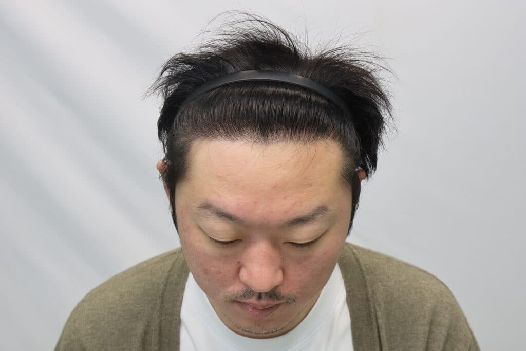 모발이식 수술 1년 후 환자 사진