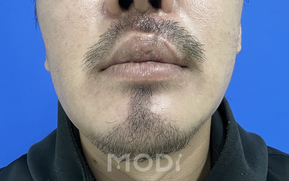 콧수염과 턱수염 수염이식 후 2주 경과 사진