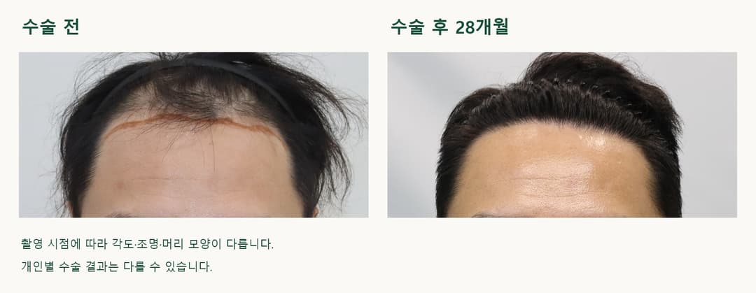 동일 환자의 모발이식 수술 전과 수술 후 28개월 전면 헤어라인 비교