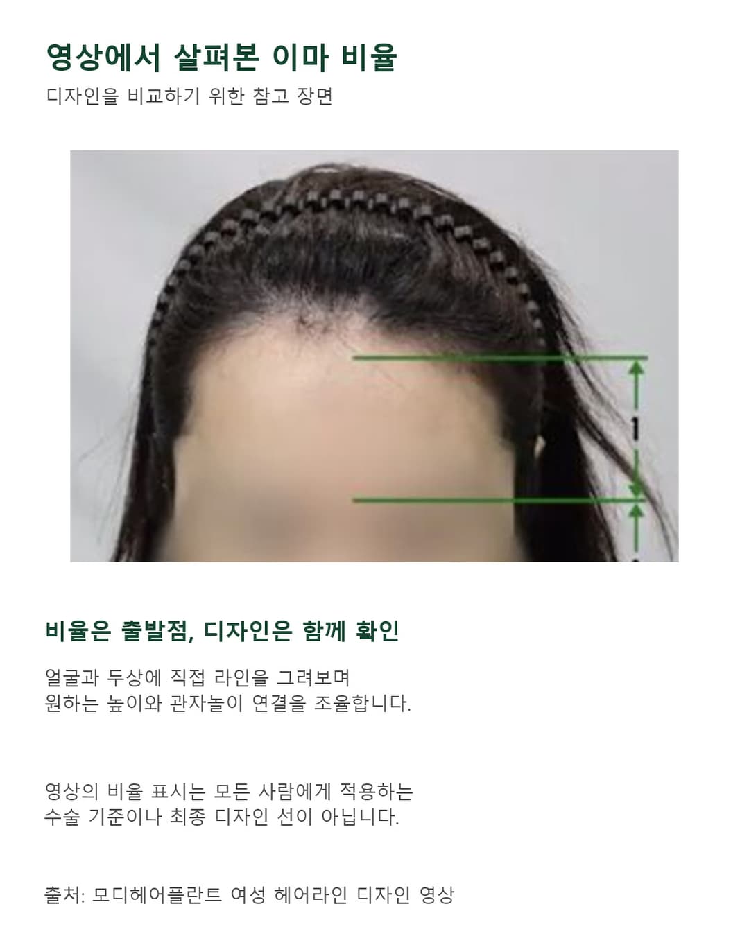 영상 속 여성 사례의 이마 비율 표시와 헤어라인 디자인 시 고려할 점