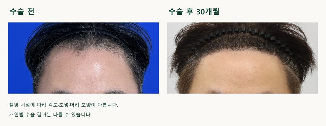 동일 환자의 모발이식 수술 전과 수술 후 30개월 머리를 뒤로 넘긴 상태의 헤어라인 비교
