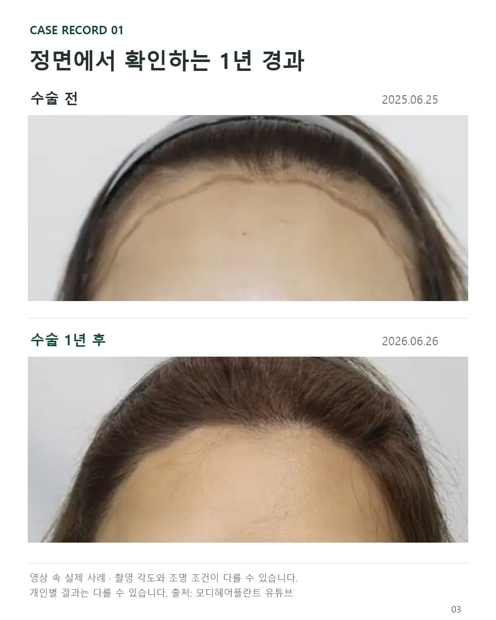 여성 헤어라인 모발이식 사례의 2025년 6월 25일 수술 전과 2026년 6월 26일 수술 1년 후 정면 사진