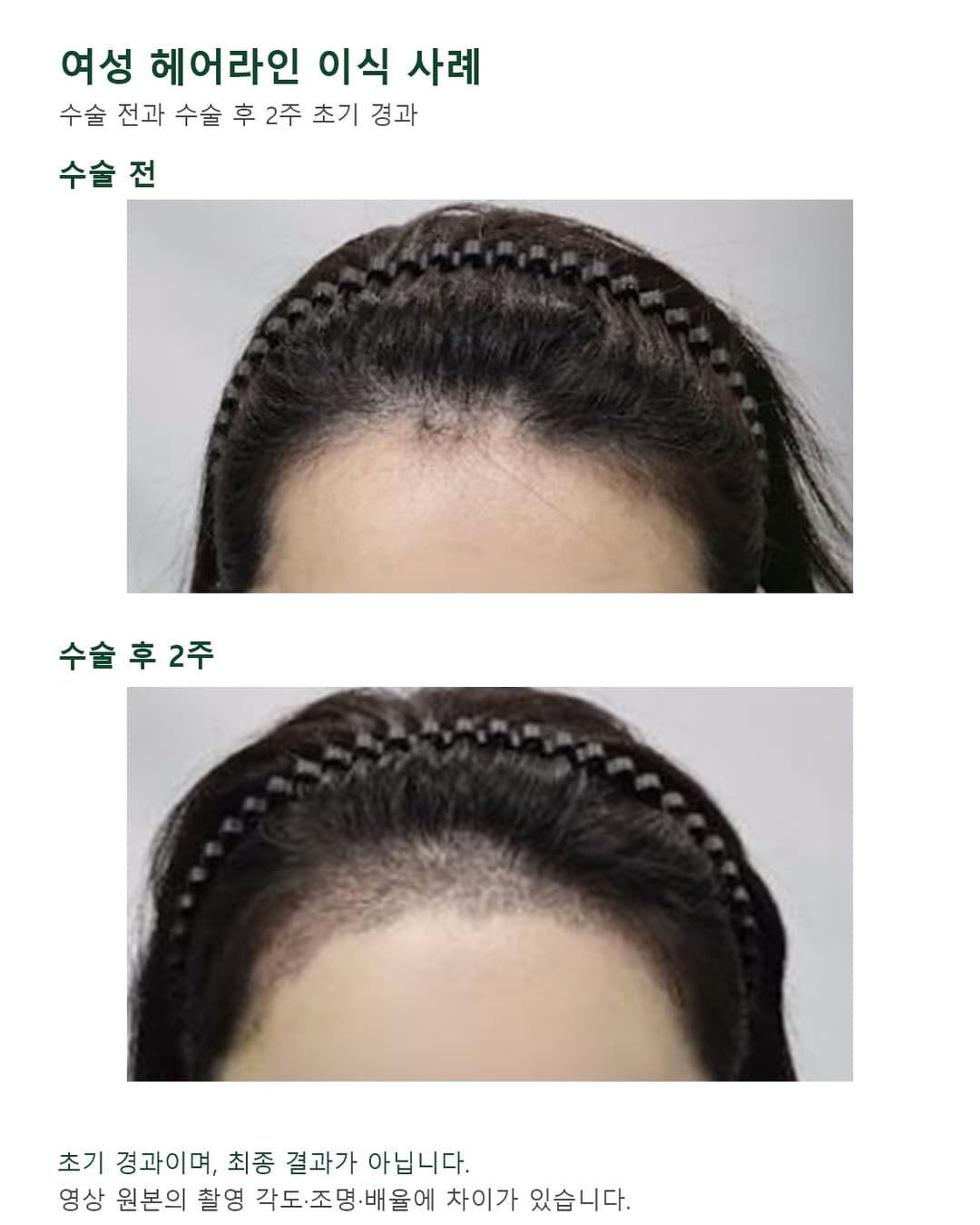 영상 속 40대 여성의 헤어라인 수술 전과 약 3500모 이식 후 2주 초기 경과 비교