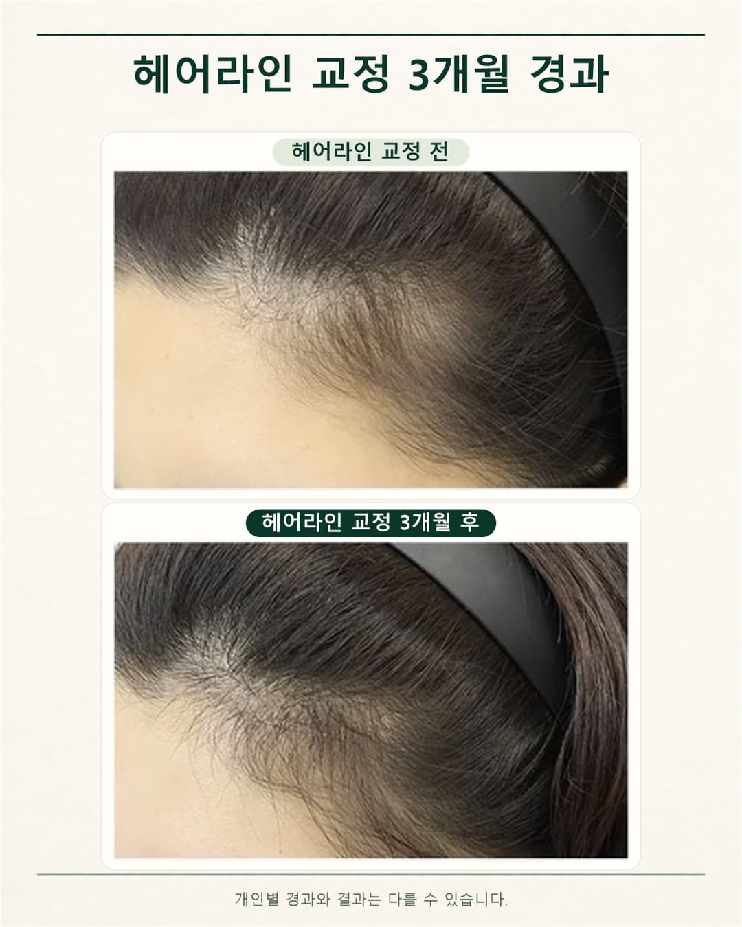 헤어라인 교정 전과 교정 3개월 후의 옆 헤어라인 사진을 위아래로 배치한 경과 비교