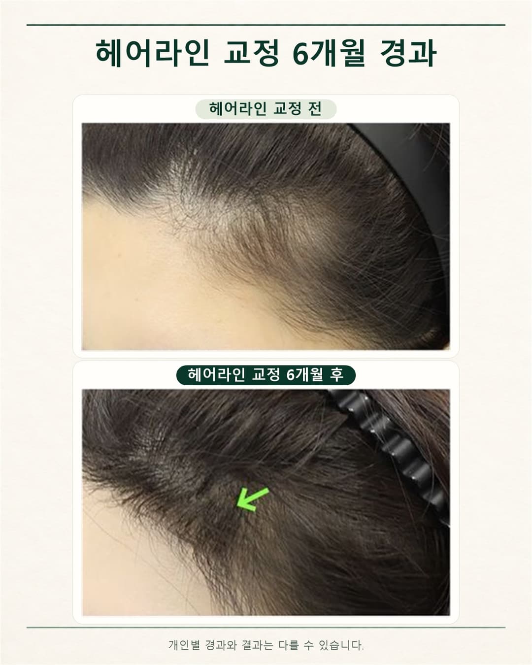 헤어라인 교정 전과 교정 6개월 후의 옆 헤어라인 사진을 위아래로 배치한 경과 비교