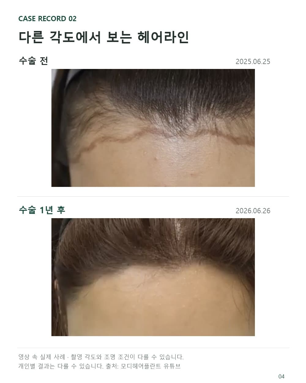 여성 헤어라인의 옆쪽 연결을 살펴볼 수 있는 수술 전과 수술 1년 후 다른 각도 비교 사진