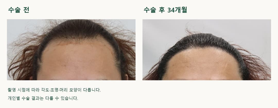 동일 환자의 모발이식 수술 전과 수술 후 34개월 중앙 및 양옆 헤어라인 비교