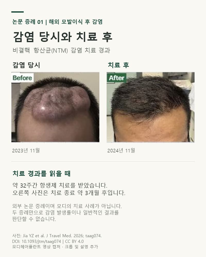 논문 첫 번째 환자의 2023년 11월 두피 감염 당시와 항생제 치료 종료 약 3개월 후인 2024년 11월 비교사진