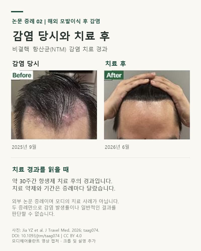 논문 두 번째 환자의 2025년 9월 두피 감염 당시와 약 30주간 치료 후인 2026년 6월 비교사진