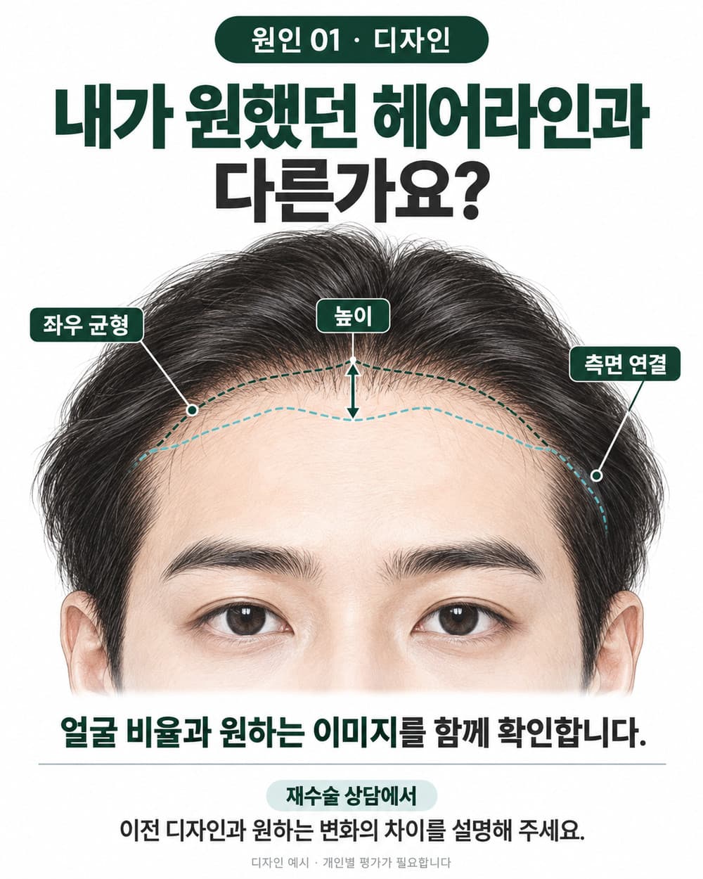 헤어라인 높이와 좌우 균형 및 측면 연결을 살펴보는 재수술 디자인 상담 도식