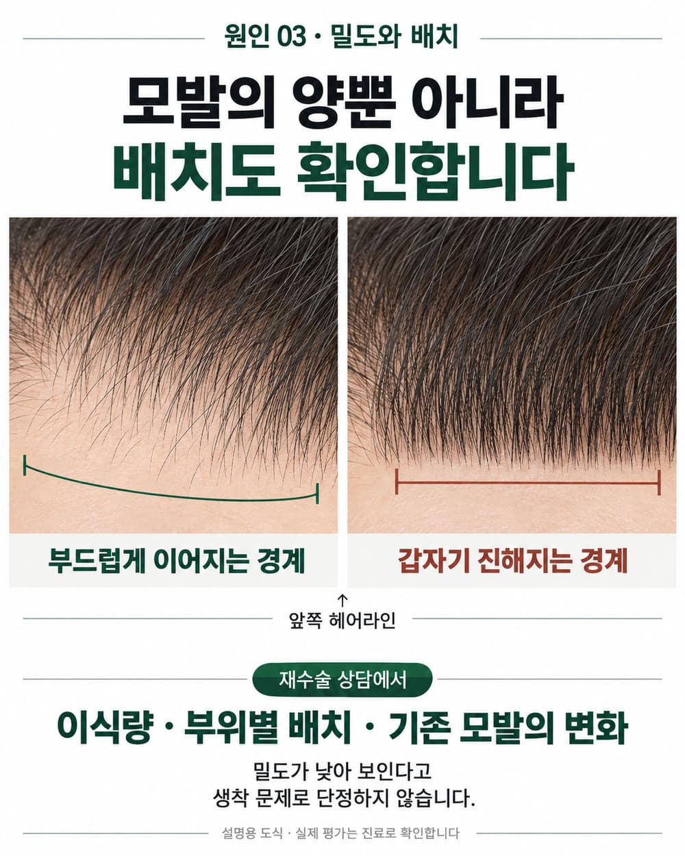 헤어라인의 앞쪽 경계가 부드럽게 이어지는 배치와 갑자기 진해지는 배치를 비교한 밀도 설명