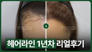 여성 헤어라인 교정 전후 비교 (1년 후기 영상)