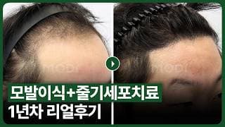 모발이식후기 남성 탈모 치료의 성지 모디헤어플란트 수술 1년 후기 I 줄기세포 탈모치료 I