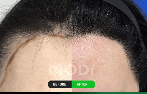 애교머리 이식 전후 비교 — 이마 헤어라인 앞 잔머리 부위