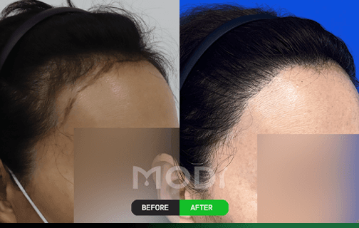 모발 방향 디자인 헤어라인 시술 전후 사례 1 — BEFORE/AFTER