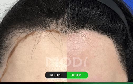 모발 방향 디자인 이마 헤어라인 시술 전후 사례 5 — BEFORE/AFTER