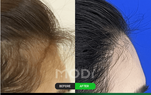 모발 방향 디자인 측면 헤어라인 시술 전후 사례 6 — BEFORE/AFTER