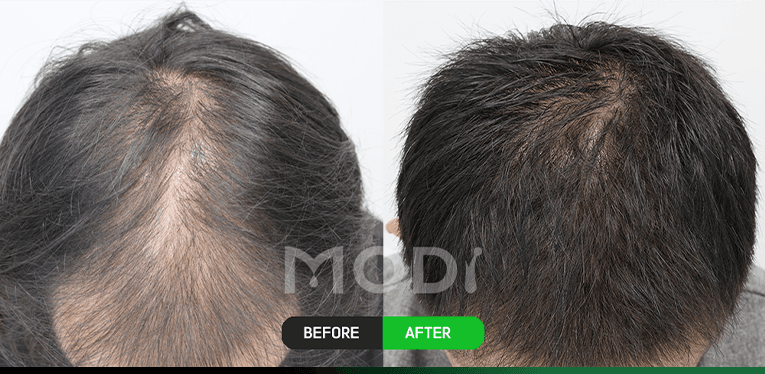 모낭줄기세포치료 전후 비교 — 정수리 BEFORE / AFTER