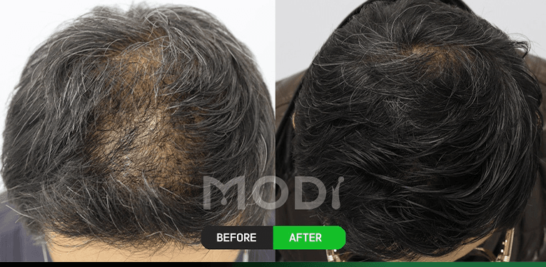 모낭줄기세포치료 전후 비교 — 정수리 BEFORE / AFTER