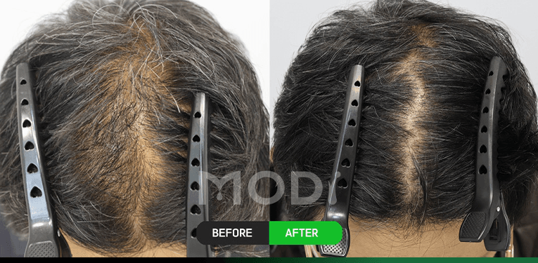 모낭줄기세포치료 전후 비교 — 정수리 BEFORE / AFTER