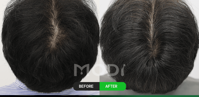 모낭줄기세포치료 전후 비교 — 정수리 BEFORE / AFTER