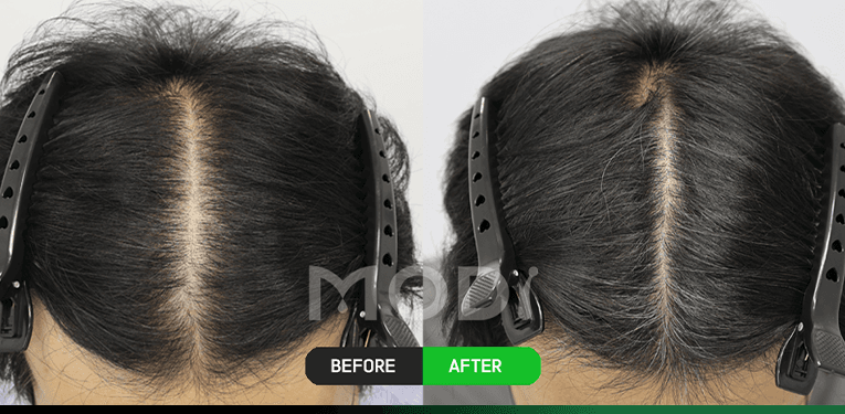 모낭줄기세포치료 전후 비교 — 정수리 BEFORE / AFTER