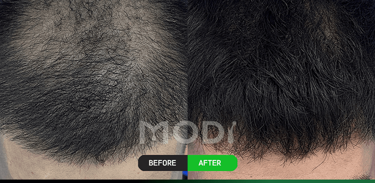 모낭줄기세포치료 전후 비교 — 정수리 BEFORE / AFTER