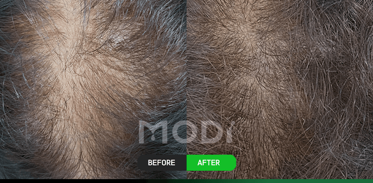 모낭줄기세포치료 전후 비교 — 정수리 BEFORE / AFTER