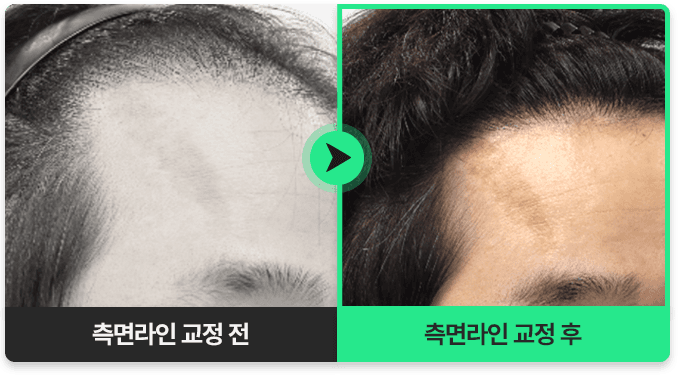 측면라인 교정 전과 측면라인 교정 후 비교 사진