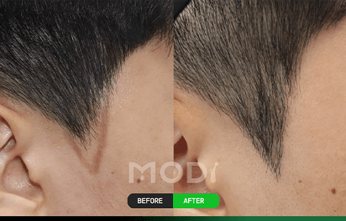 구레나룻 모발이식 전후 비교 사진 — BEFORE와 AFTER 측면 모습