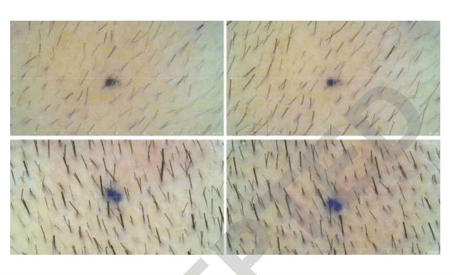 연구 참가자가 먹는 약·바르는 약·기능성 샴푸 등 다른 탈모치료를 중단한 상태에서 진행했음을 나타낸 그림