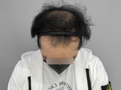 모발이식+모낭줄기세포 병행 효과, 6개월 사례