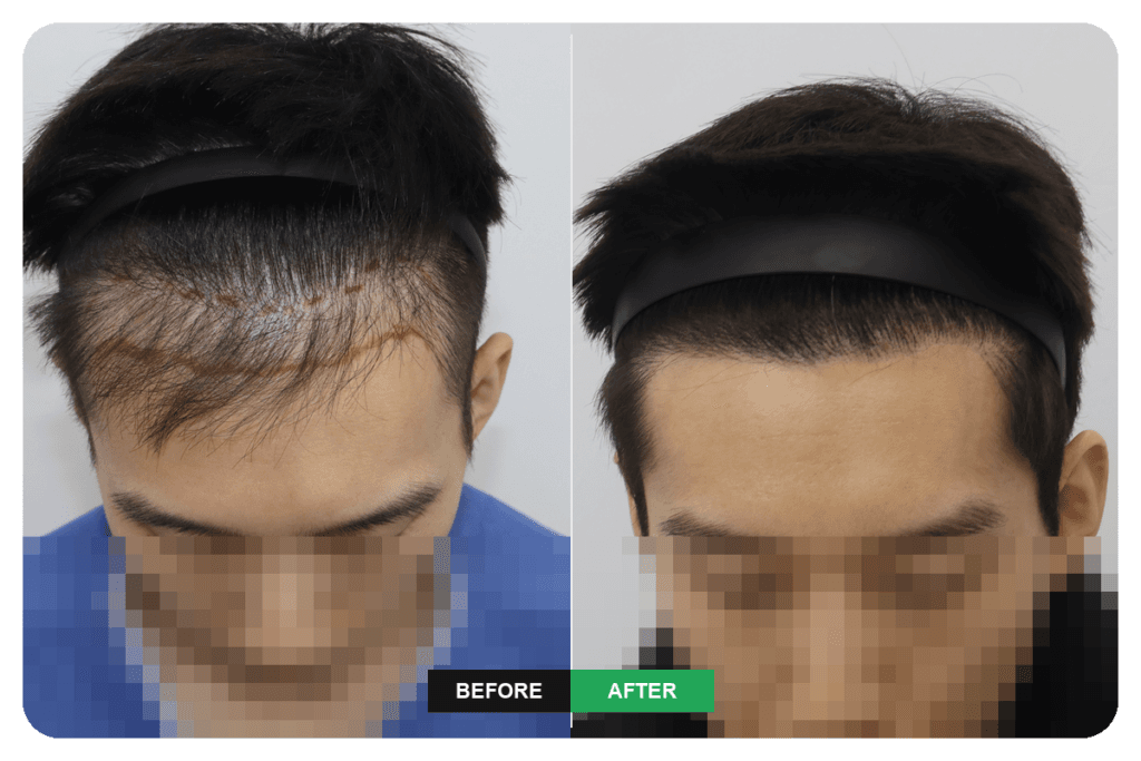 절개와 비절개 모발이식 후 헤어라인 재수술