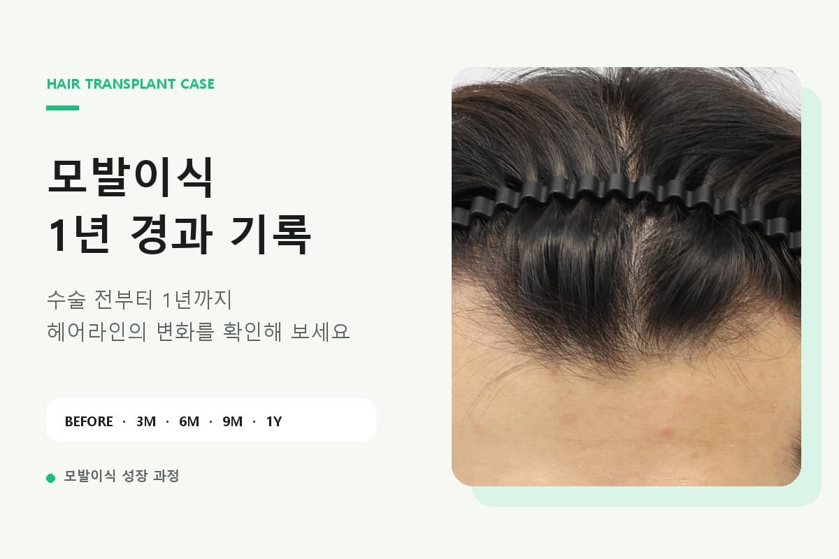 M자 모발이식 2600모 전후|3개월·6개월·1년 변화 과정